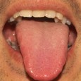 【舌診学】潰瘍性大腸炎,アトピー性皮膚炎/症例No.11 潰瘍性大腸炎,アトピー性皮膚炎の舌写真。
症状の改善に伴う舌の変化を、
舌写真を用いて紹介。