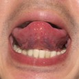 【舌診学】多発性筋炎 / 症例No.16 多発性筋炎の疑いのある方の症例。
症状の改善に伴う舌の変化を、
舌写真を用いて紹介。