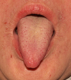 ＜舌診学＞アトピーのとある症例