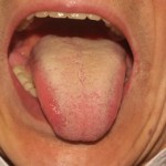 【舌診学】便秘と下痢 / 症例No