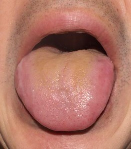 【舌診学】多発性筋炎の疑い/症例No.16