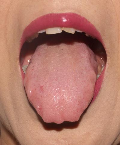【舌診学】体全体の痛み,微熱/症例No.17