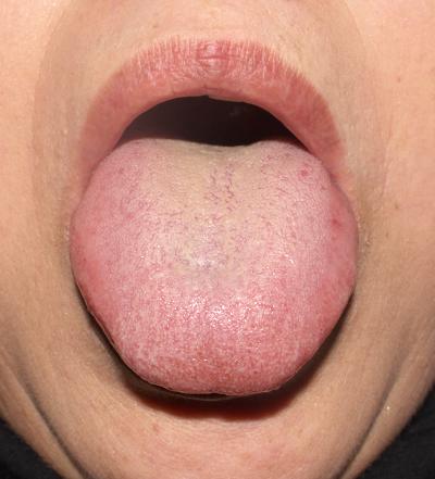 【舌診学】喘息,蓄膿,高血圧,腰痛,過敏性腸症候群/症例No.18