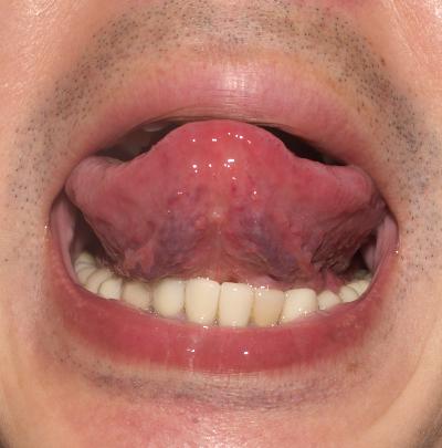 【舌診学】多発性筋炎の疑い/症例No.16（舌裏）