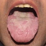 【舌診学】潰瘍性大腸炎/ 症例No.22