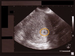 M.Aさん　妊娠５週目 超音波(エコー)写真