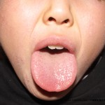 アトピー患者　舌診