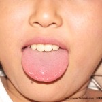 アトピー患者　舌診