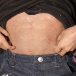 アトピー患者　腹診