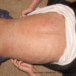 アトピー患者　望診　背部