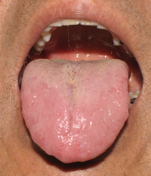 しびれ 舌 の
