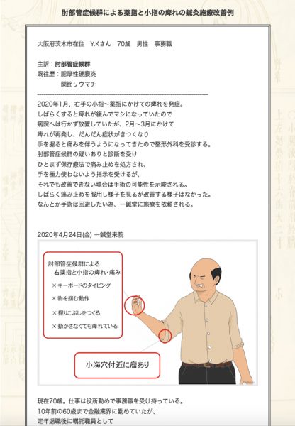 【症例集】肘部管症候群：大阪府茨木市のY.K様
