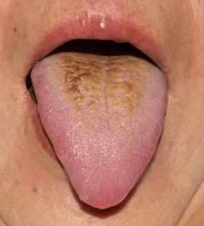 乳癌手術後の肩の痛みの舌診画像/大阪(豊中市 吹田市)の鍼灸院,一鍼堂