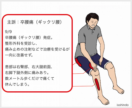 ギックリ腰への鍼灸治療