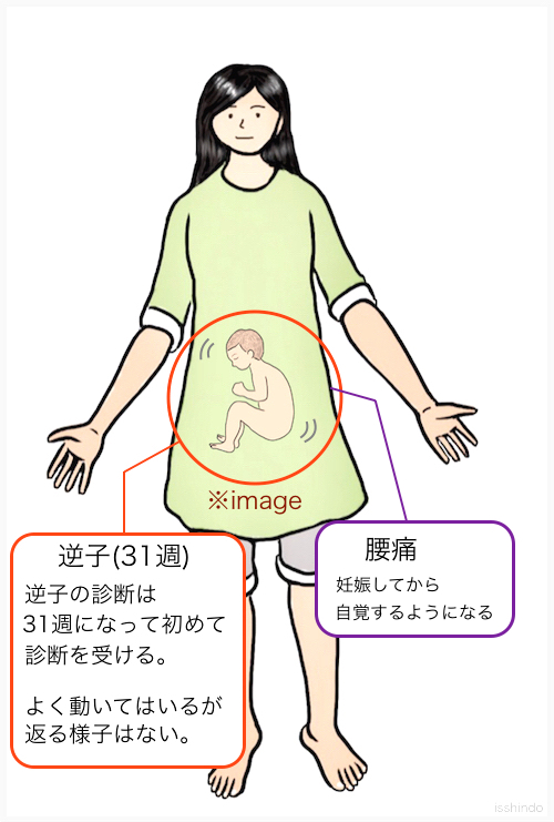 治ら ない 逆子